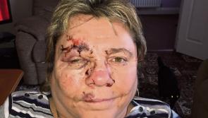 Woman was &lsquo;flung&rsquo; out of wheelchair in collision with car outside Limerick hospital